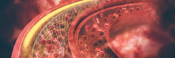 ЛЕКЦИЯ "МОЖНО ЛИ РАСТВОРИТЬ ХОЛЕСТЕРИНОВЫЕ БЛЯШКИ"